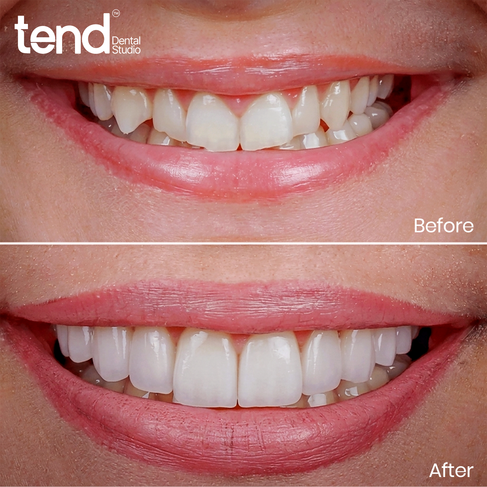 02 - TEND DENTAL STUDIO - BEFORE AFTER